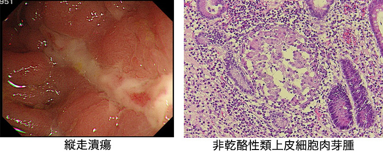 肉芽腫がある場合、クローン病はどのように治療しますか?