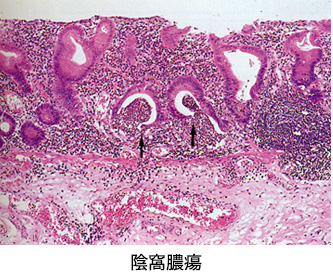 陰窩膿瘍